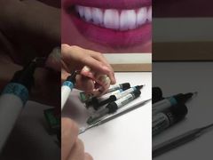 On the gingiva of the Titanium Malong hybrid bridge