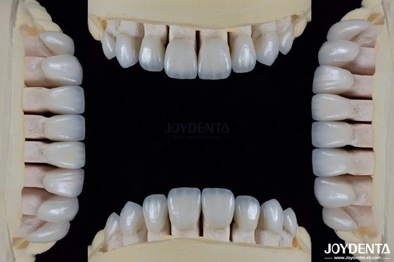 Ceramika do naturalnej estetyki Finery dentystyczne odporne na plamy utrzymuje jasność Silne połączenie z szkliwością zębów dla bezpiecznego dopasowania