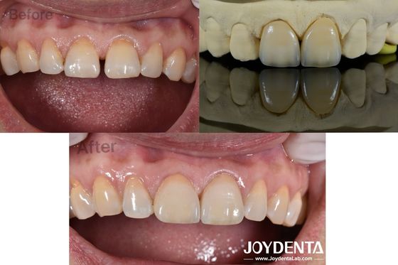 0.5mm grubość zębowe finery Perfekcyjna przepuszczalność porcelanowe finery dla dziur zębów
