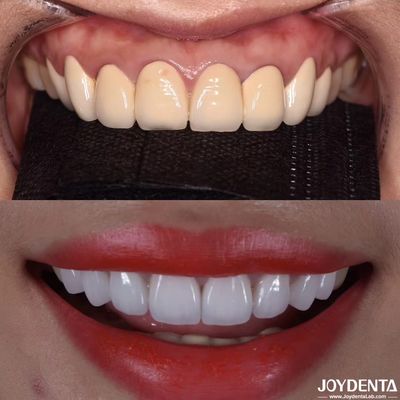 CAD/CAM Kompatybilne korony dentystyczne z cyrkonii Precyzyjna produkcja dla dostosowanych odcieni i rozmiarów