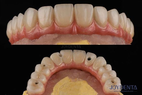 kupować Placówka do implantu zębów o szorstkiej powierzchni produkcja online