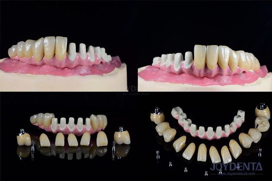 kupować Wielokrotne implanty dentystyczne wewnętrzne do odbudowy całego łuku produkcja online