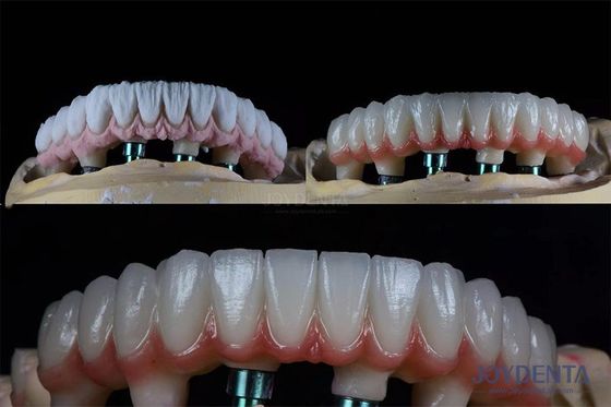 kupować 10 mm Wielokrotne zęby Dwuetapowy zestaw implantów stomatologicznych dla endosesowej korony protezy produkcja online