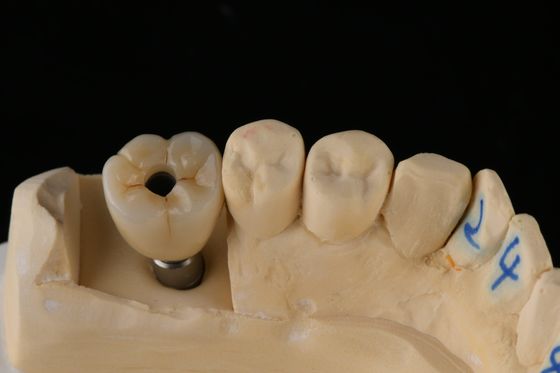 kupować 3.75mm srebrny titanowy śrubkowy implant zębowy pojedynczy implant zębowy produkcja online