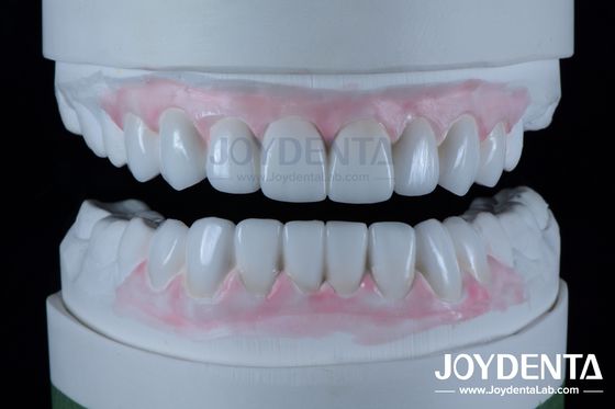 kupować Wysoce precyzyjne odbudowy zębów Woksu w stomatologii 1-2 mm grubości produkcja online