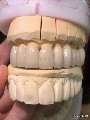 kupować Precyzyjna porcelana stopiona do metalu Korony PFM Bezszwedzka naturalna poprawa uśmiechu produkcja online