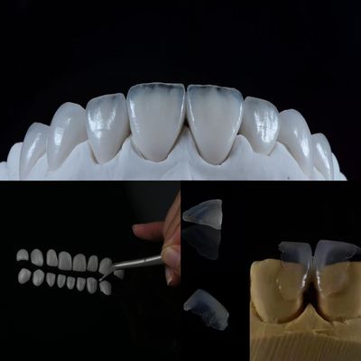kupować Szklano-ceramiczna winowańka - uzyskaj naturalnie wyglądający uśmiech dzięki temu doskonałemu rozwiązaniu stomatologicznemu produkcja online