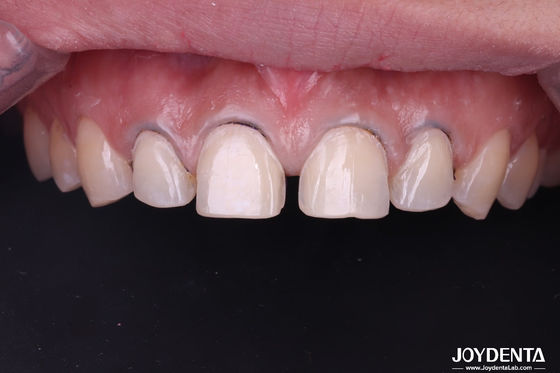 kupować Kosmetyczna Stomatologia Lab Dental Veneers. Premium Porcelana & Composite Veneers Outsourcing - Joydentalab produkcja online