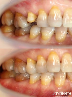 kupować Dostosowalny przystępny cenę dentystyczny wkład restauracyjny precyzyjnie dopasowany do uszkodzonych zębów produkcja online