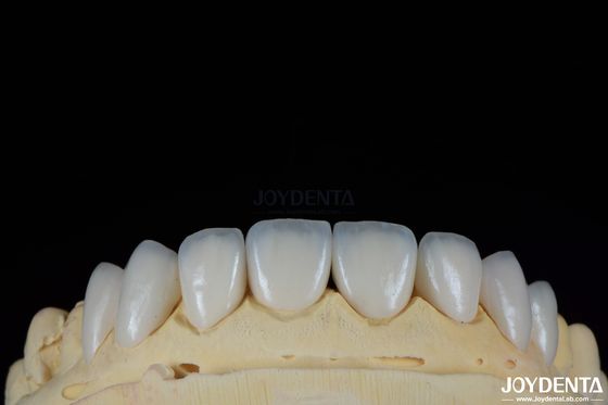 kupować Brilliant Surface Texture Feldspathic Veneer Naturalnie wyglądająca folia porcelanowa produkcja online