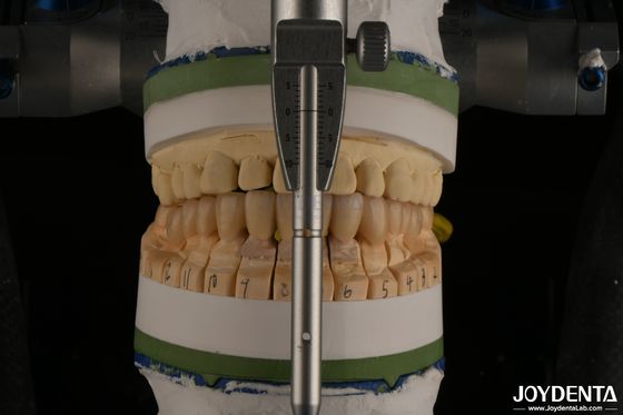 kupować Wysoka estetyka porcelanowa zirkonia stomatologiczna z warstwami do odbudowy implantów produkcja online