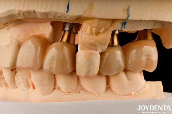 kupować Odbudowa brakujących zębów Implant Korona i mostek Bezpieczny do użycia doustnego z dokładnym dopasowaniem produkcja online