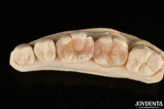 kupować Naturalny polimeryzowany porcelanowy wkład do zębów Onlay do odnowy zębów produkcja online