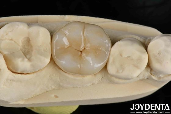 kupować Cementowanie klejące Zirkonia Inlays i Onlays dentystyczne naturalny wygląd produkcja online