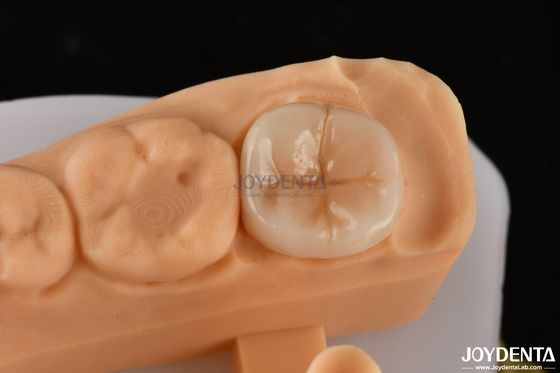 kupować 0.5mm-2mm Precyzyjne dopasowanie Emax Dental Inlay Onlay dla niezawodnego odbudowy zębów produkcja online
