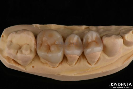 kupować Naturalny wygląd Emax Inlay Onlay Długotrwała restauracja zębów 0,5 mm 1 mm 1,5 mm grubość produkcja online
