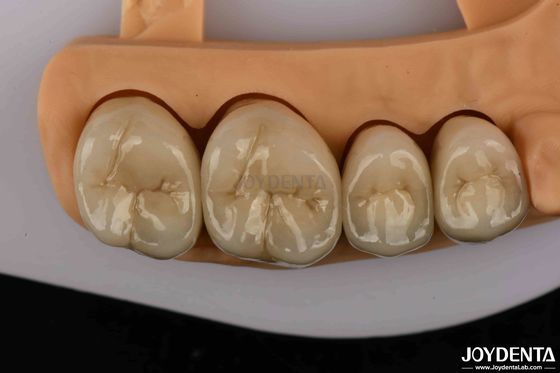 kupować Krony dentystyczne z złota i stopów paladium z wyższej jakości dla zwiększonej trwałości produkcja online
