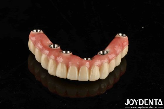 kupować Zębowy most z implantami malo z tytanu łączący tradycyjne i nowoczesne techniki produkcja online