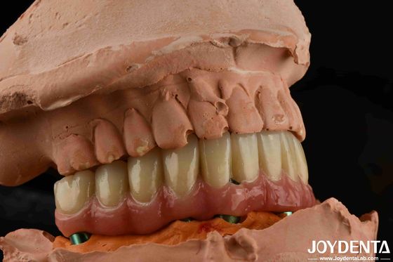 kupować Niska gęstość tytanu Malong Hybrid Bridge Dental Lekkie produkcja online