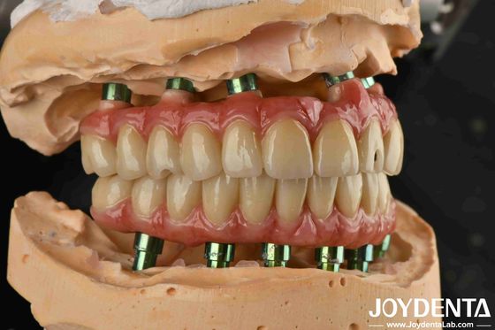 kupować Hybrydowa technologia Titanium Malong Dental Bridge regulowany dla efektów estetycznych produkcja online