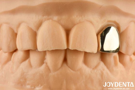 kupować Złoto 60K Metalowa korona ustna Odporna na ścieranie Korona dentystyczna Woksowo odlewana produkcja online