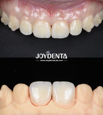 kupować Lekkie, gładkie powierzchnie Zirkonia mostki dentystyczne do implantów wspieranych restauracji produkcja online