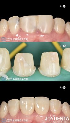 kupować Doskonale dopasowane zęby Zirconia Korony zębowe z systemami CAD CAM do precyzyjnej produkcji produkcja online