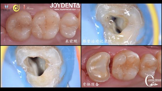 kupować Długotrwałe, naturalnie wyglądające, dentystyczne ceramiczne wkładki Precyzyjne dopasowanie Wysoka kompatybilność produkcja online