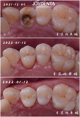 kupować Precyzyjne dopasowanie zębów z porcelany dentystycznej do zębów uszkodzonych dla dorosłych i dzieci produkcja online