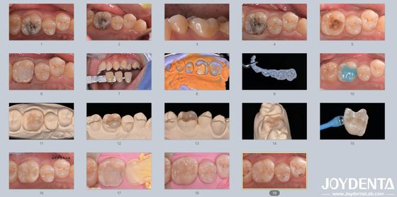 kupować Dorośli Dzieci Porcelanowe ceramiczne wkładki dentystyczne Odbudowujące uszkodzone zęby produkcja online