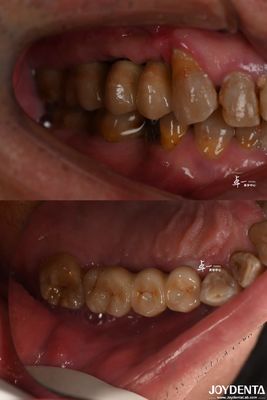 kupować Zębowy implant o szorstkiej powierzchni do podkręgowego poziomu kości z materiału tytanu produkcja online