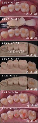 kupować Bezszwedzony pas Porcelanowy wkład Dental Procedura Kustomowalny kształt Do naprawy zębów produkcja online