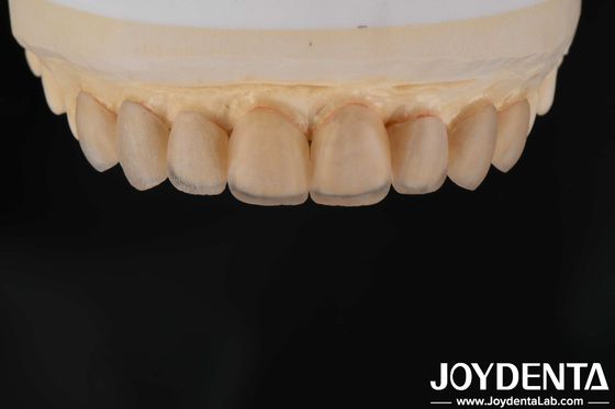 kupować Naturalny wygląd Szklane, ceramiczne finery, kliniki stomatologiczne Finery produkcja online