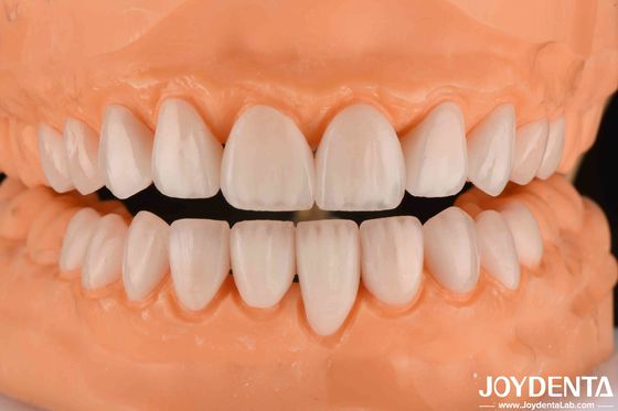 kupować Ceramic Emax Veneers 0,3-0,5 mm Grubość Długotrwałe kosmetyczne folia porcelanowa produkcja online