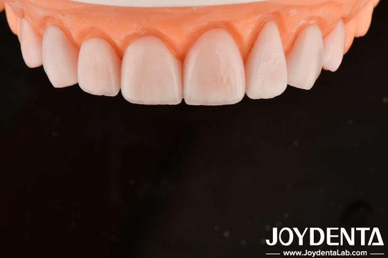 kupować IPS Porcelan Emax Finery Zębowe Restauracje Odporne na szczeliny produkcja online