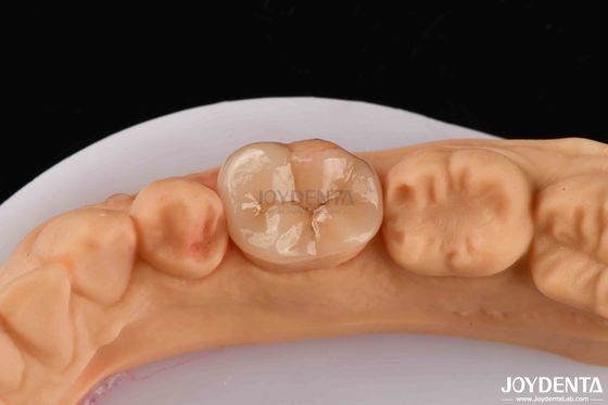 kupować Wysoka wytrzymałość Inlay zębowy Onlay kompozyt naturalny wygląd produkcja online