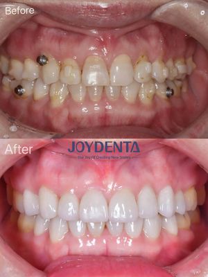 kupować Zębowe fajerwerki dla brakujących zębów. Global Premium Dental Lab Services produkcja online