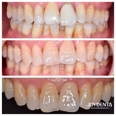 kupować Korony Premium Zirconium | Globalne Outsourcing Laboratoriów Dentystycznych | JOY Dental Lab produkcja online