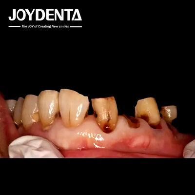 kupować Korony Premium Zirconia dla Globalnych Laboratoriów Dentystycznych | JOY Dental Lab produkcja online