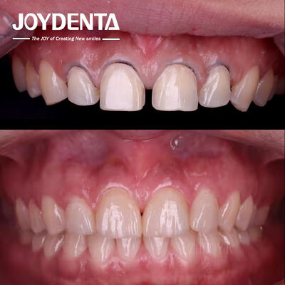 kupować Kosmetyczna Stomatologia Lab Dental Veneers. Premium Porcelana & Composite Veneers Outsourcing - Joydentalab produkcja online
