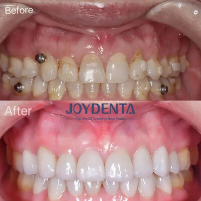 kupować Zębowe fajerwerki dla brakujących zębów. Global Premium Dental Lab Services produkcja online