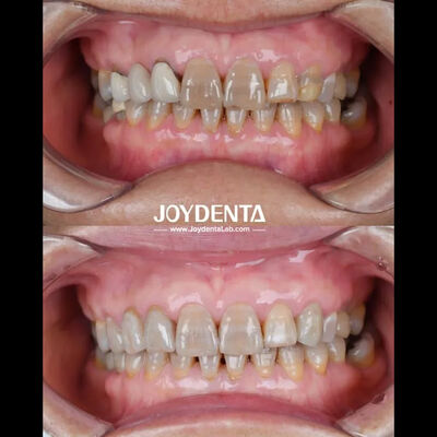 kupować Lekkie Zirkonia Stomatologiczna dla optymalnego doświadczenia pacjenta produkcja online