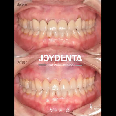 kupować Tlenek cyrkonu dentystyczny dla bezpieczeństwa tkanek jamy ustnej i kompatybilności CAD/CAM produkcja online