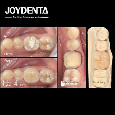 kupować Biokompatybilność i wysoka zgodność z naturalnymi odbudowami zębów produkcja online