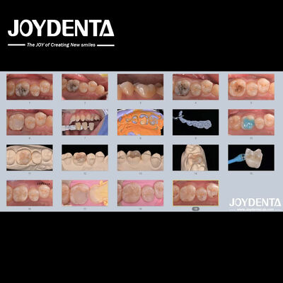 kupować Dorośli Dzieci Porcelanowe ceramiczne wkładki dentystyczne Odbudowujące uszkodzone zęby produkcja online