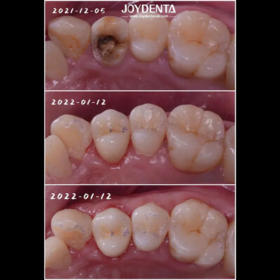 kupować Precyzyjne dopasowanie zębów z porcelany dentystycznej do zębów uszkodzonych dla dorosłych i dzieci produkcja online