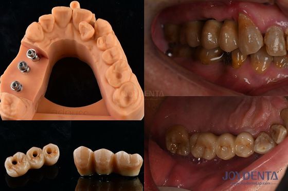 Ultra twarda stabilność koloru Korona implantu dentystycznego OEM Łatwe utrzymanie Długotrwałe