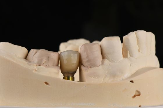 Implant z pojedynczym zębem z samodzielnym sznurkiem i wewnętrznym połączeniem sześciokątnym