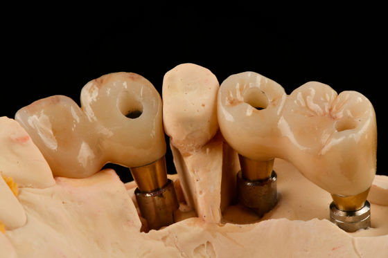 Samodzielnie wyciągający 3,0 mm sznurowy implant stomatologiczny z tytanu z zoptymalizowaną funkcjonalnością