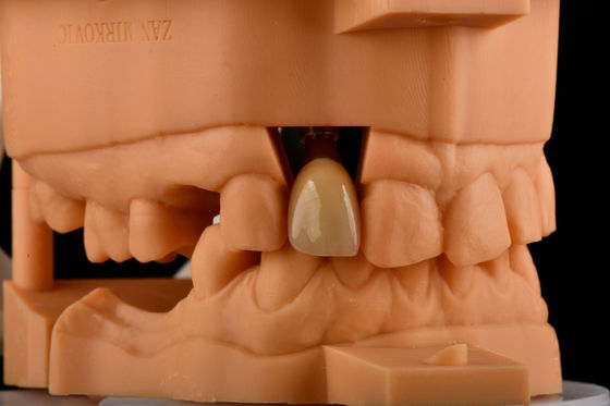 Wewnętrzny heks 3,0 mm Głębokość 1,5 mm Pitch Jednorazowy implant zębowy z tytanu